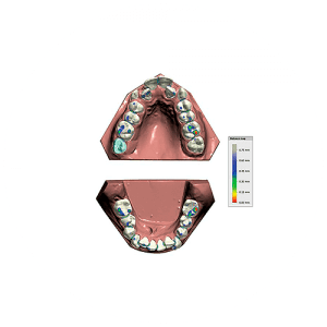 Exocad Software Modul - Icon Ortho Modul