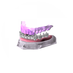 Exocad Software Modul - Icon Steg Modul